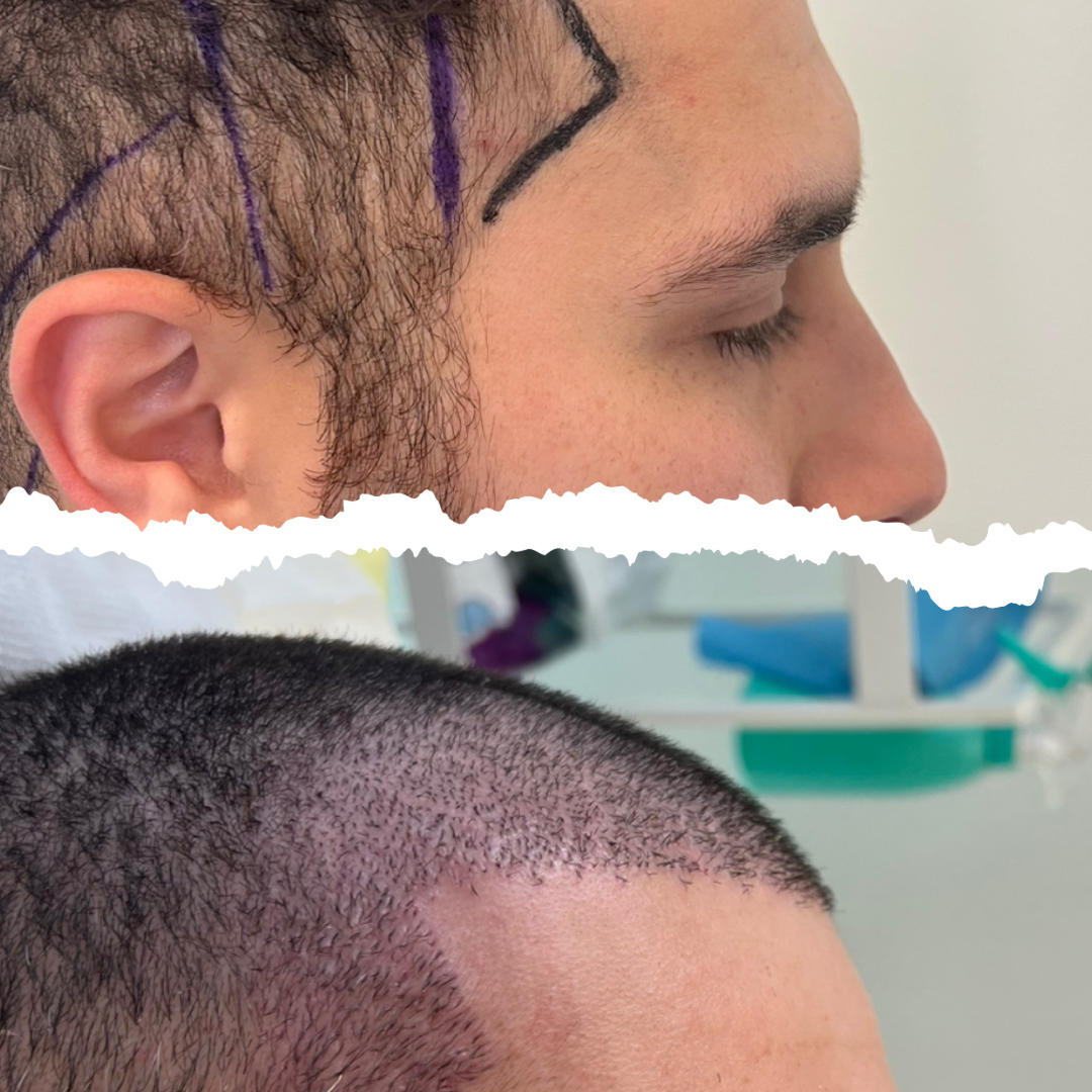 Clinician performing FUE hair transplantation with precision during a hair restoration procedure