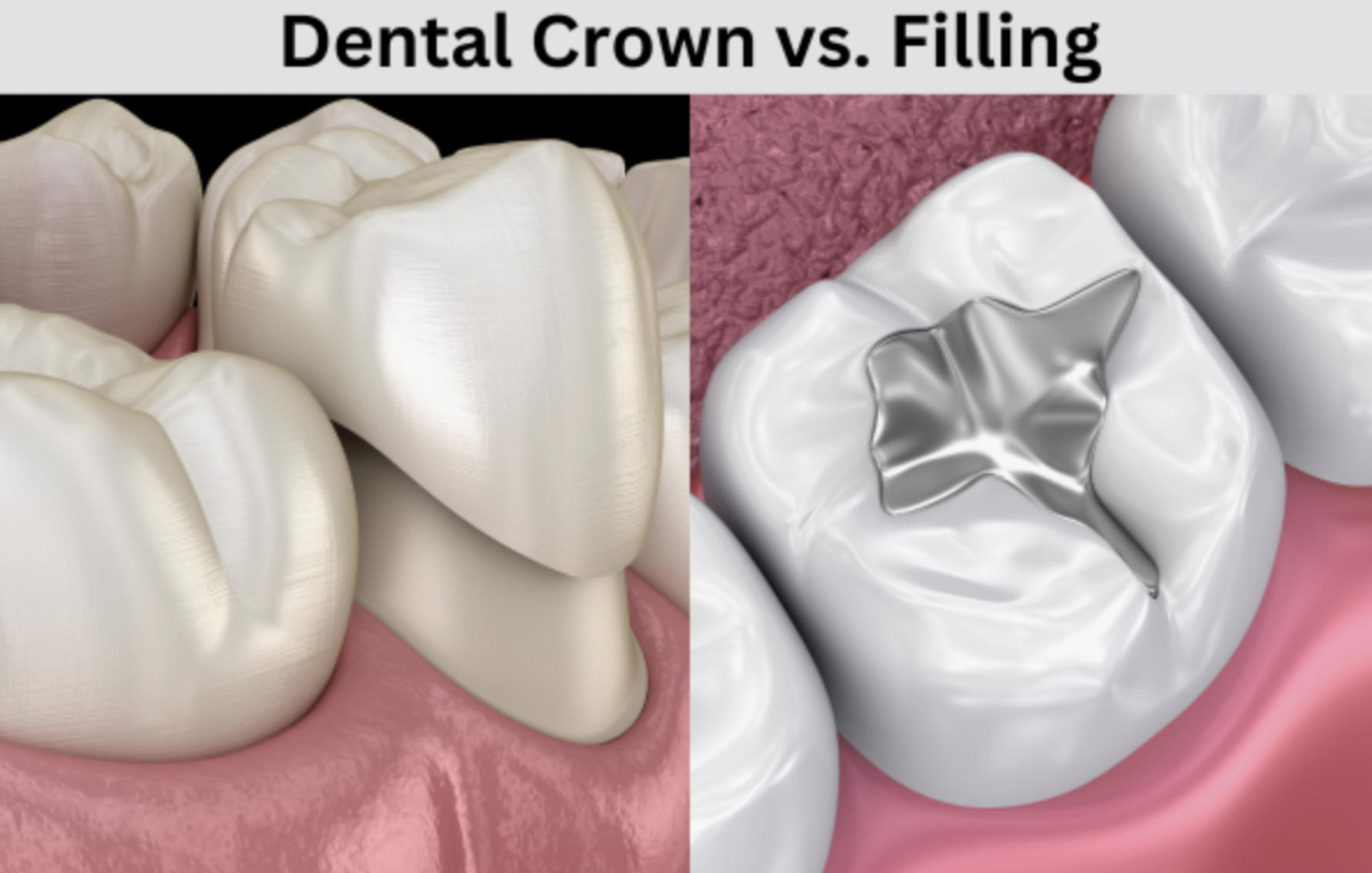 Restoration for Missing Fillings and Crowns