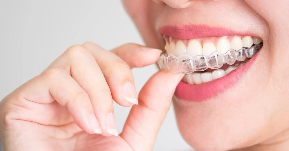Understanding Invisalign