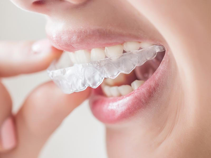 An Overview of Invisalign