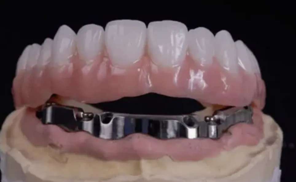 Unveiling the Advantages of Full-Arch Restoration Over Traditional Dentures