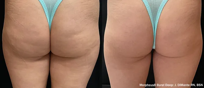 Before and after LUXORA treatment — buttocks contouring results