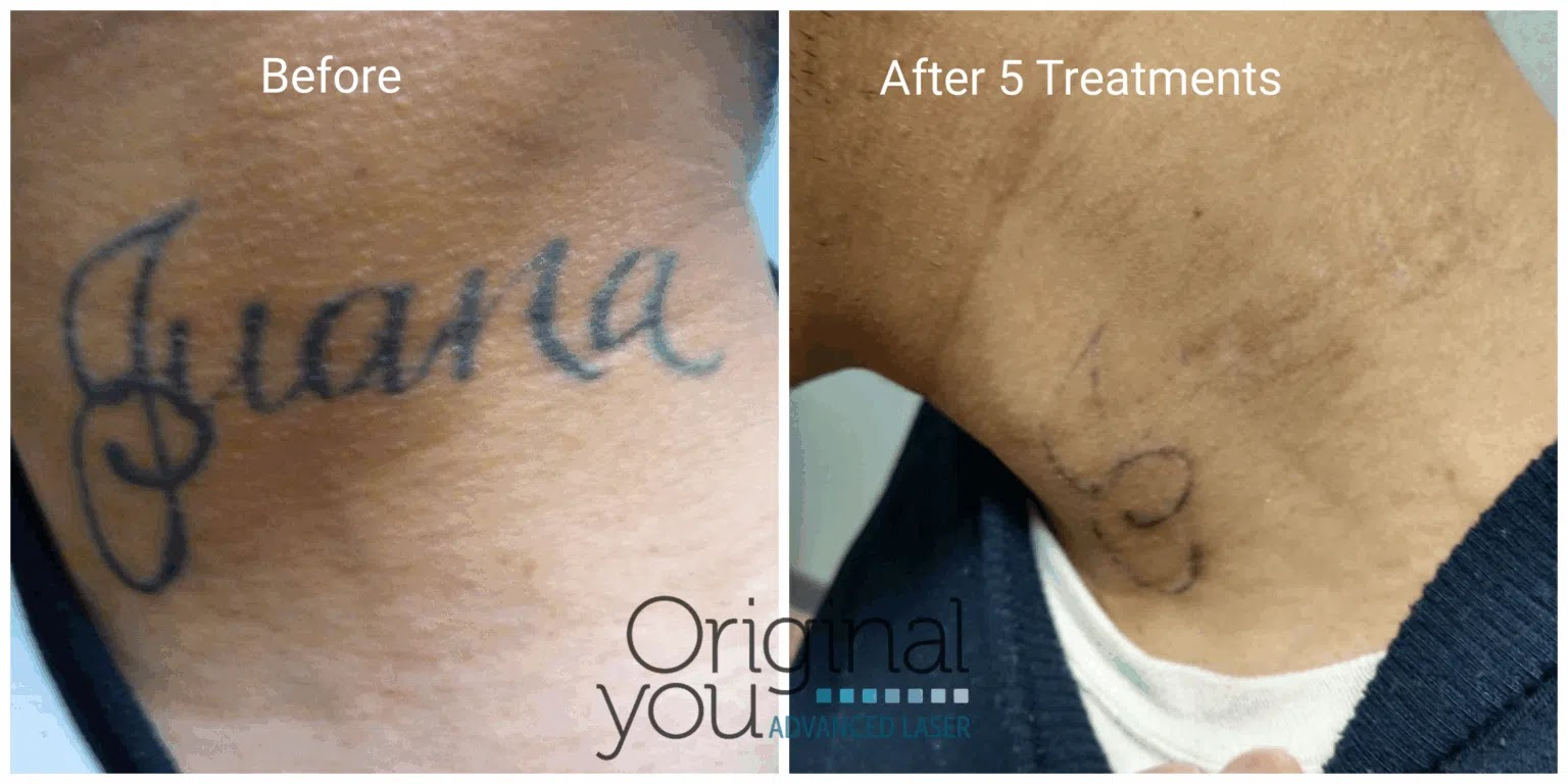 Benefits of Laser Tattoo Removal