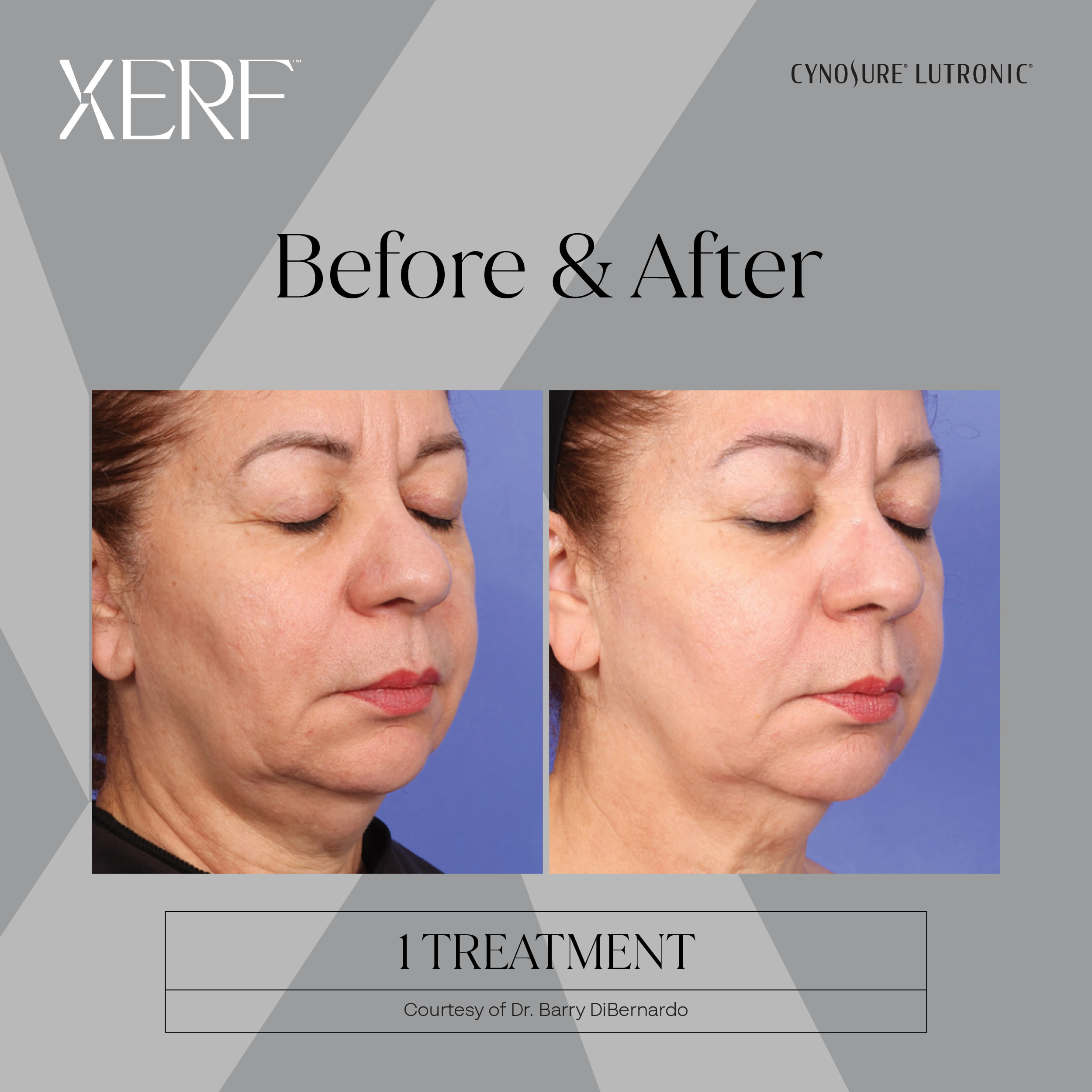 Experience Premier XERF Skin Tightening in Miami Lakes