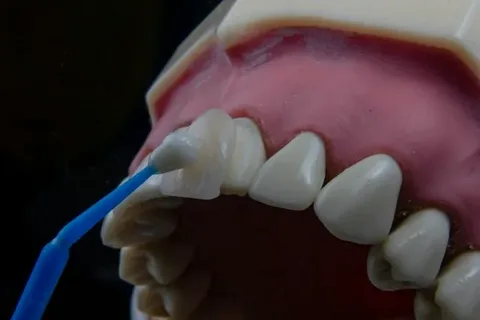 Expert Guide to the Enamel Prep Process for Veneers