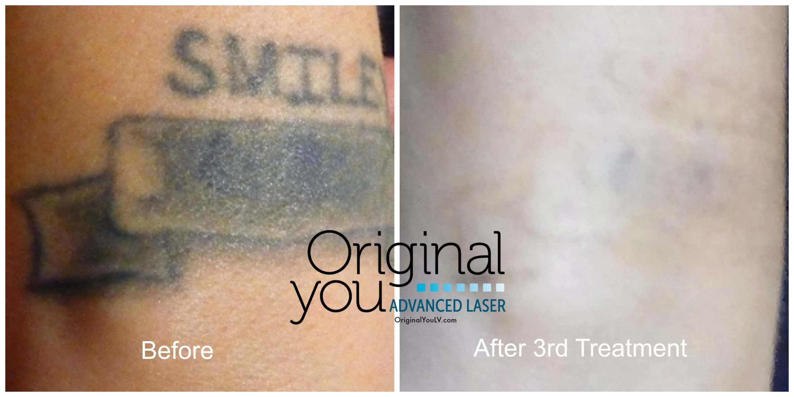 Discover the Enlighten III Laser Technology