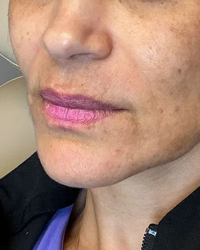 Expert Consultation for Lip Fillers in Marin County