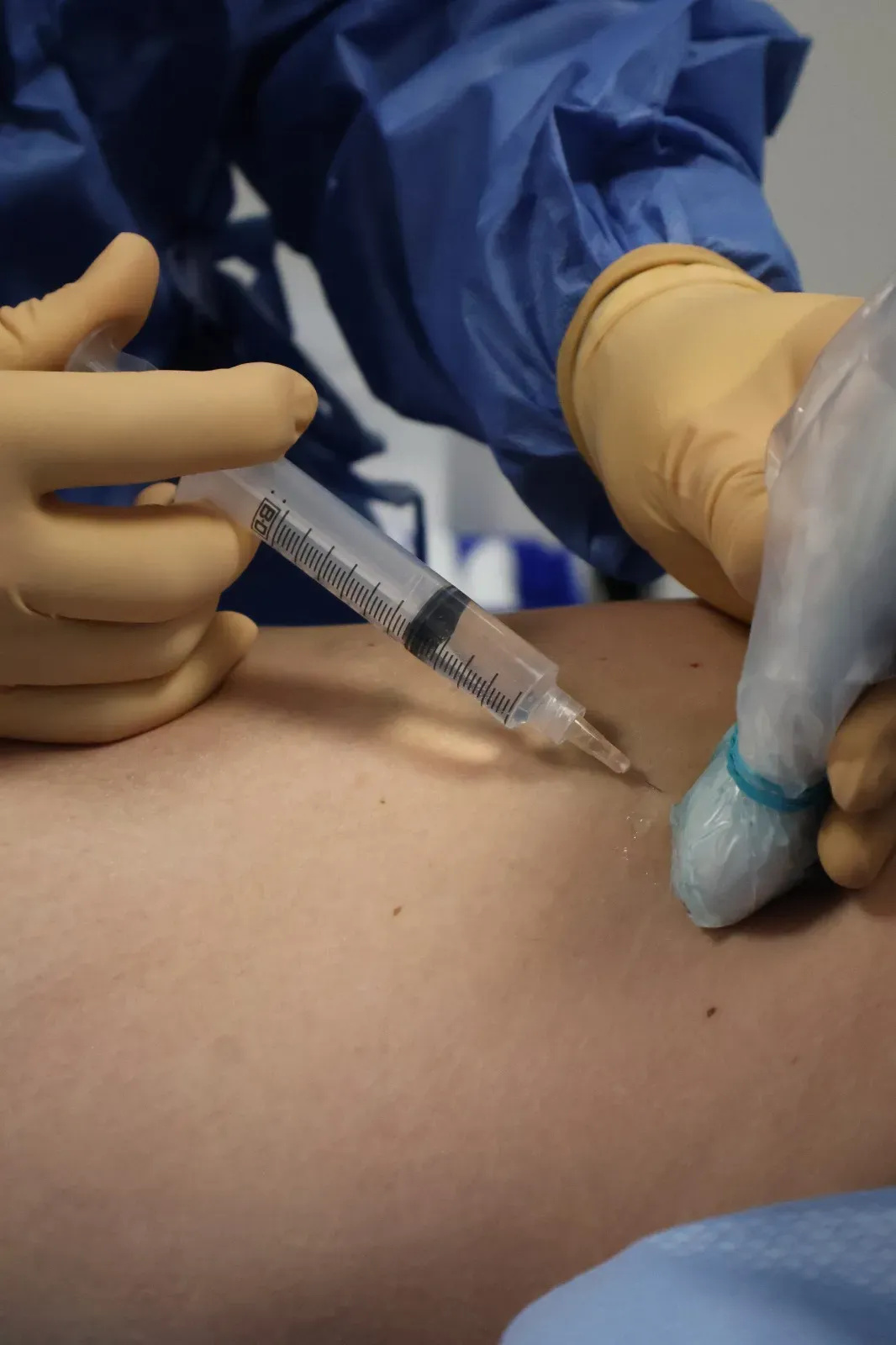 Understanding Spider Veins