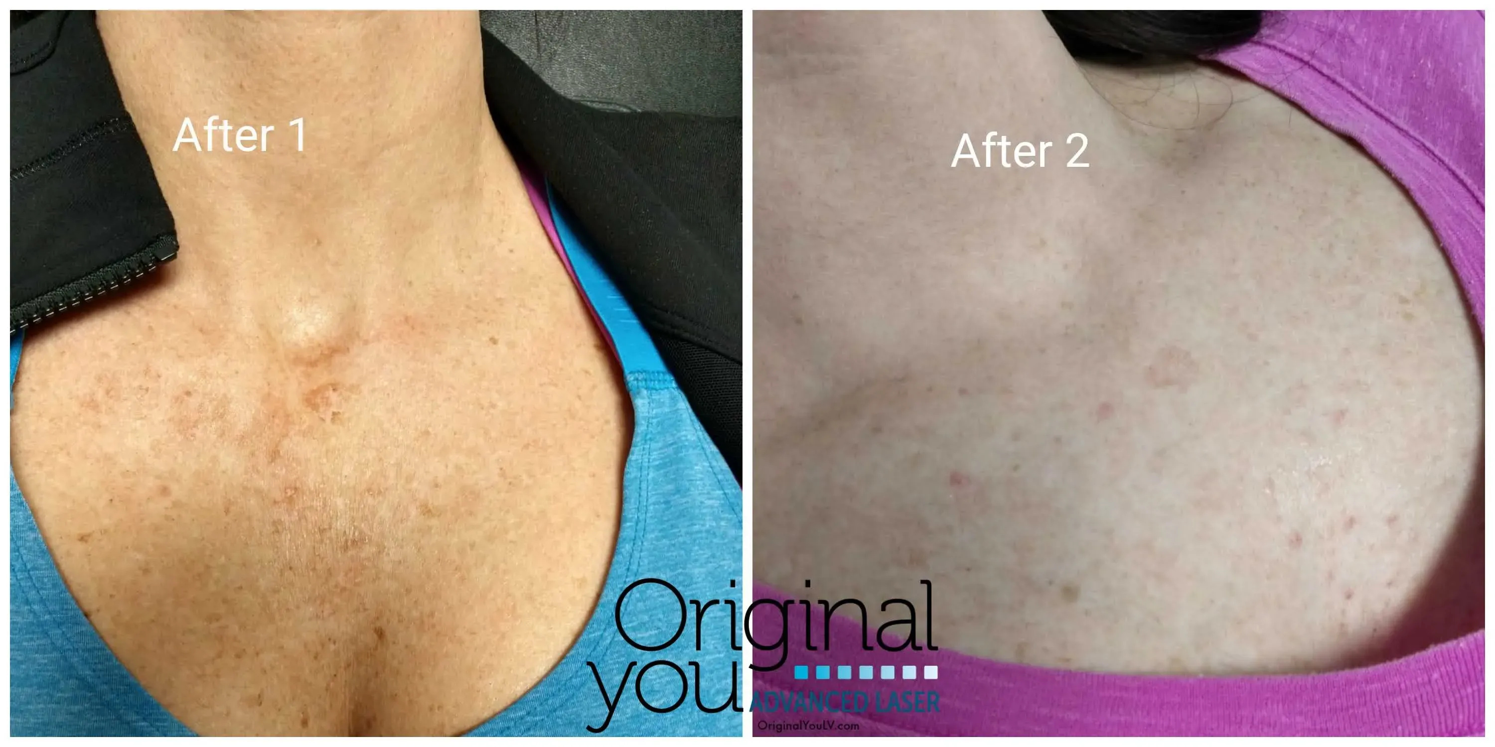Exceptional Laser Tattoo Removal in Las Vegas, NV
