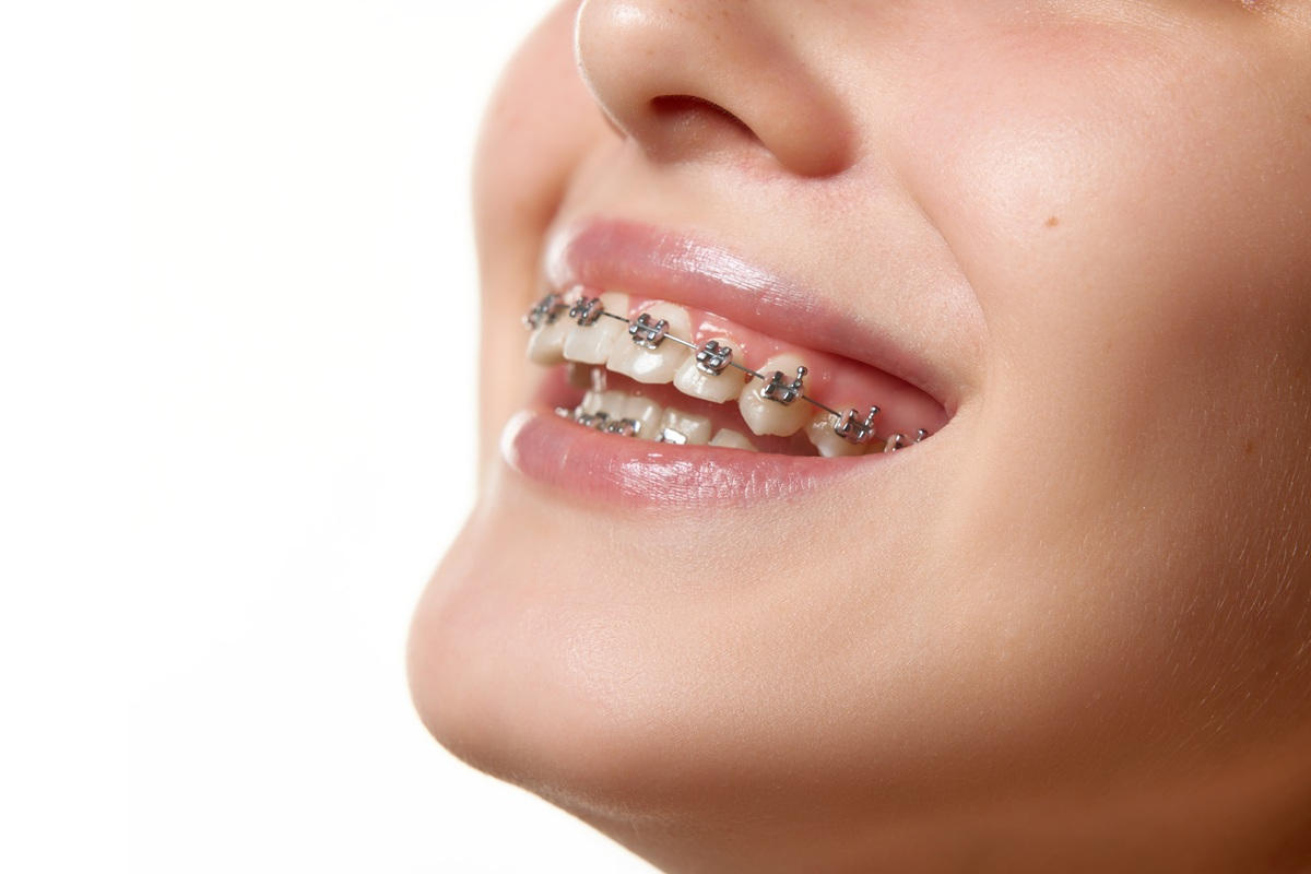 Advanced Braces in Plano