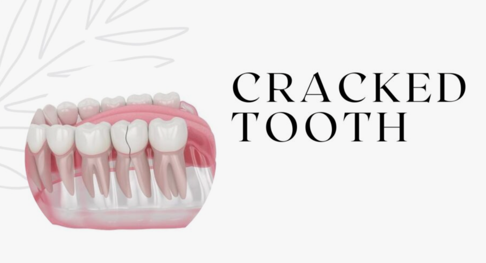 Understanding Cracked Teeth