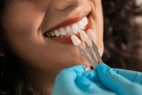 Benefits of Dental Veneers