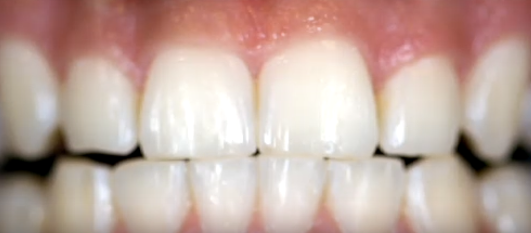 Porcelain Veneers vs. Dental Bonding: Making the Right Choice