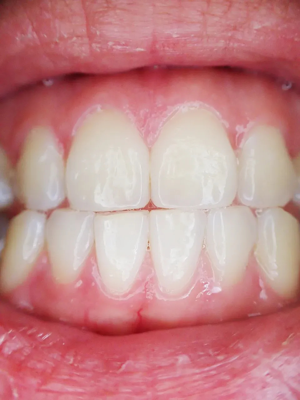 Smiling patient displaying bright teeth, signifying successful cosmetic dental treatment outcomes