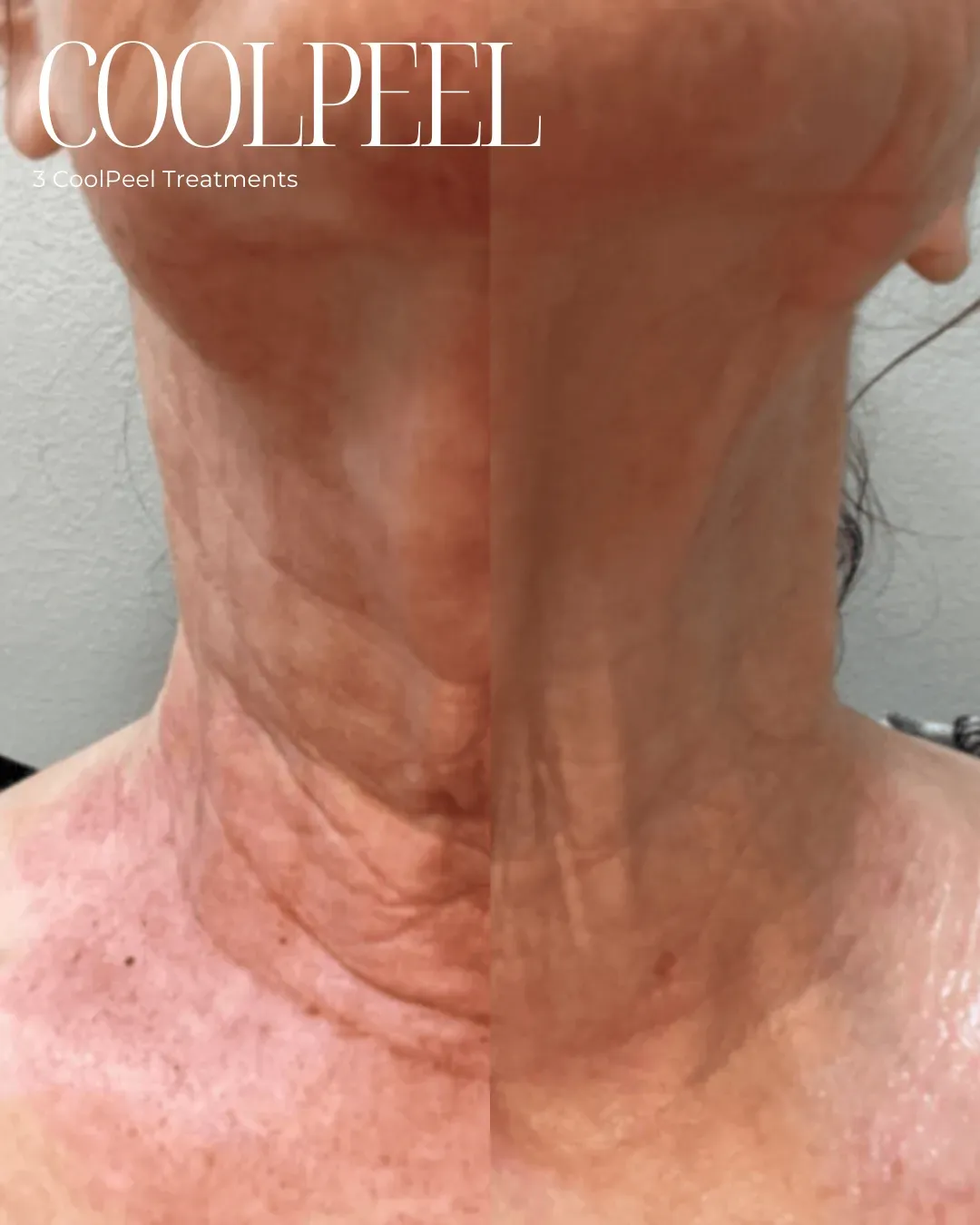 Advanced Laser Solutions for Skin Rejuvenation