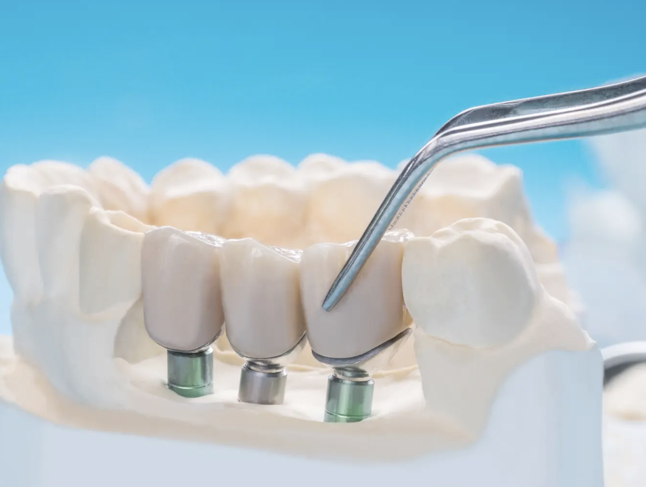 The Detal Implant Procedure Explained