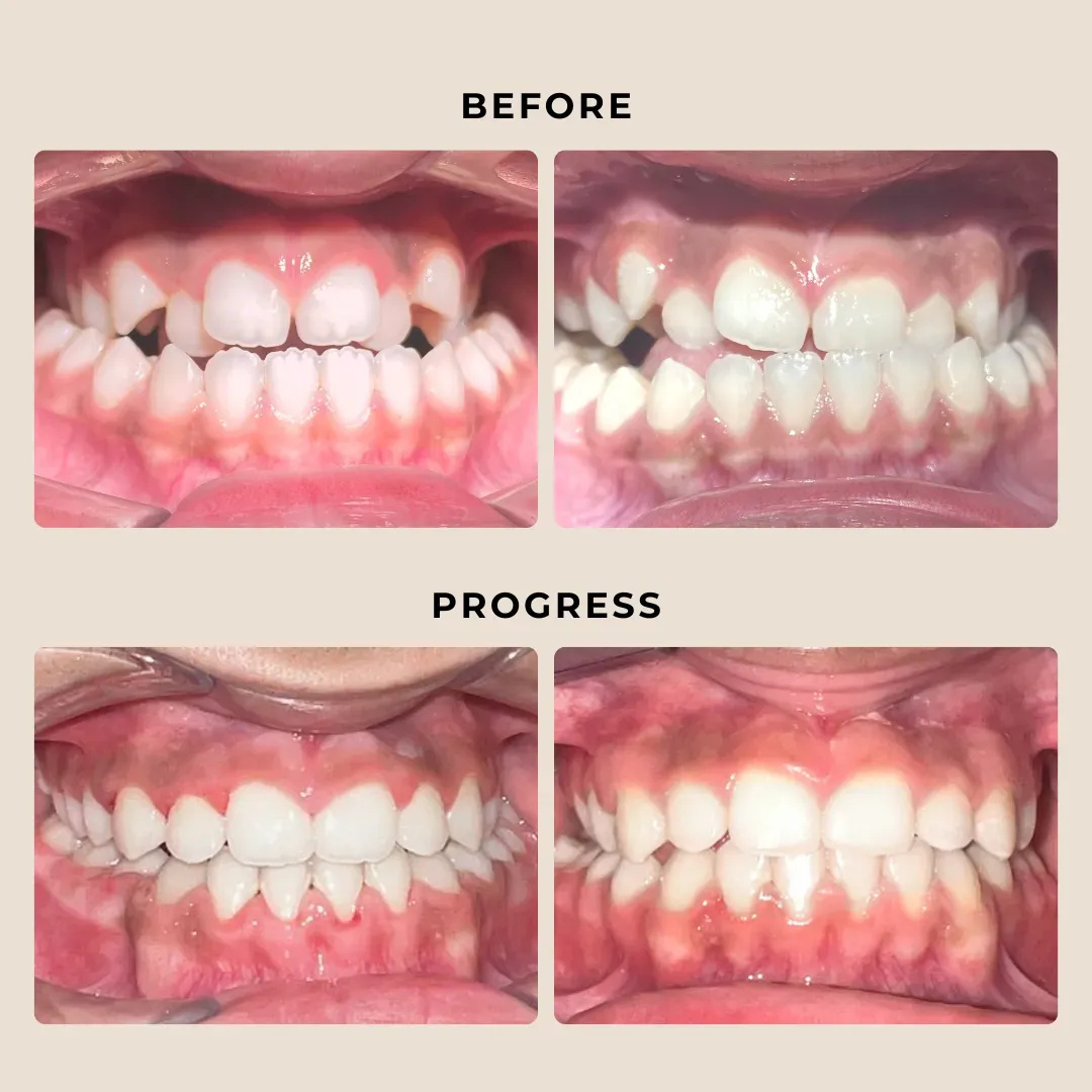 Vivera vs. Essix Retainers: Which is Right for You?