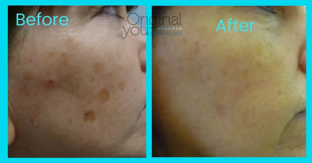The Tattoo Removal Process at Original You