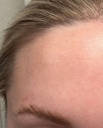 Achieving Lasting Hair Reduction