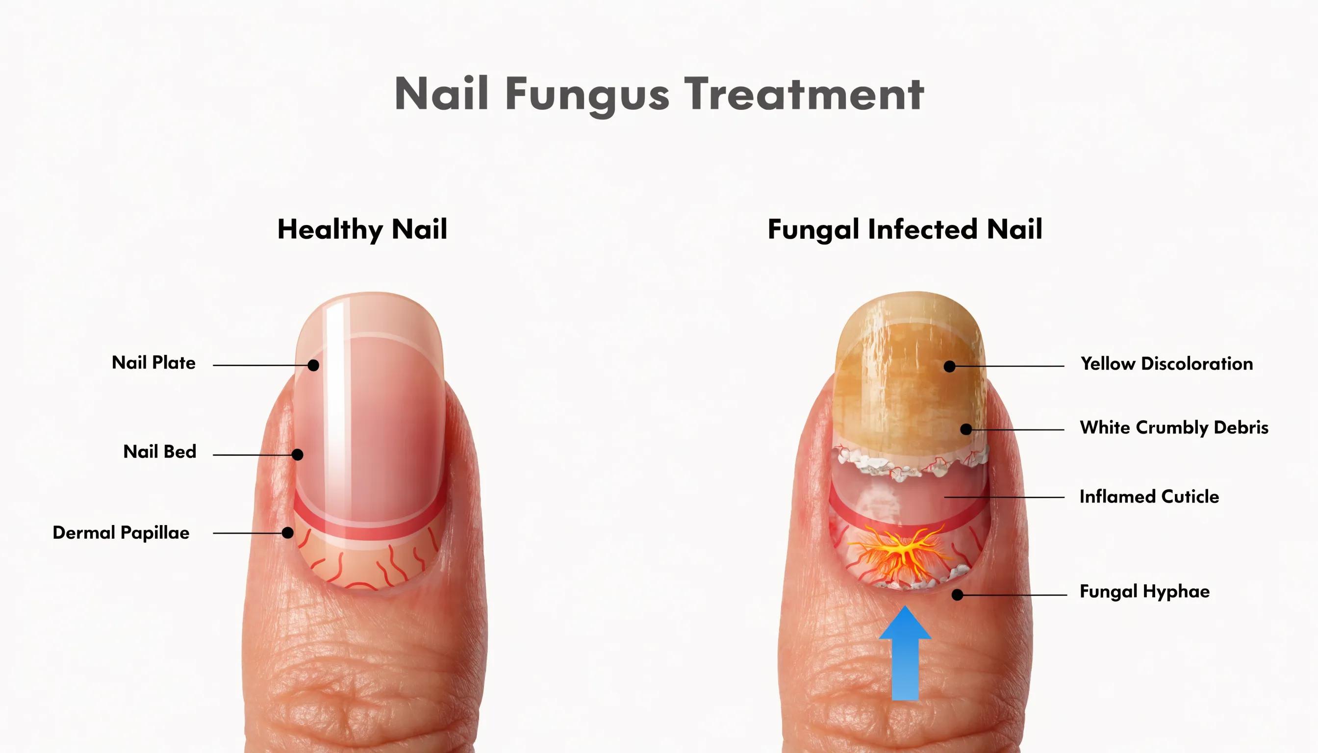 Comparison of healthy and fungus-infected nails illustrating nail fungus treatment