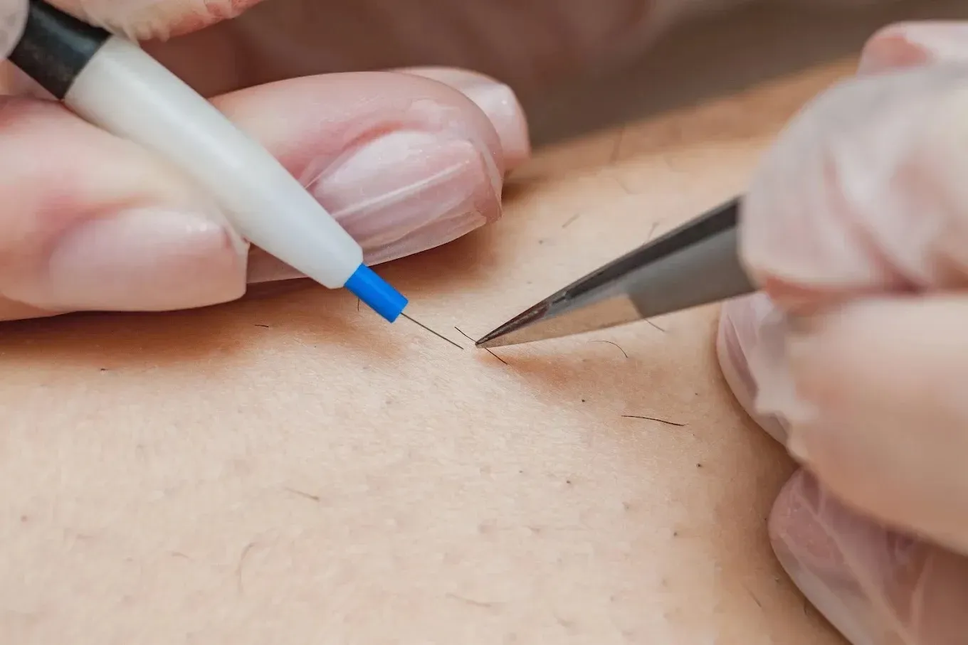 Demonstration of electrolysis techniques suitable for sensitive dark skin