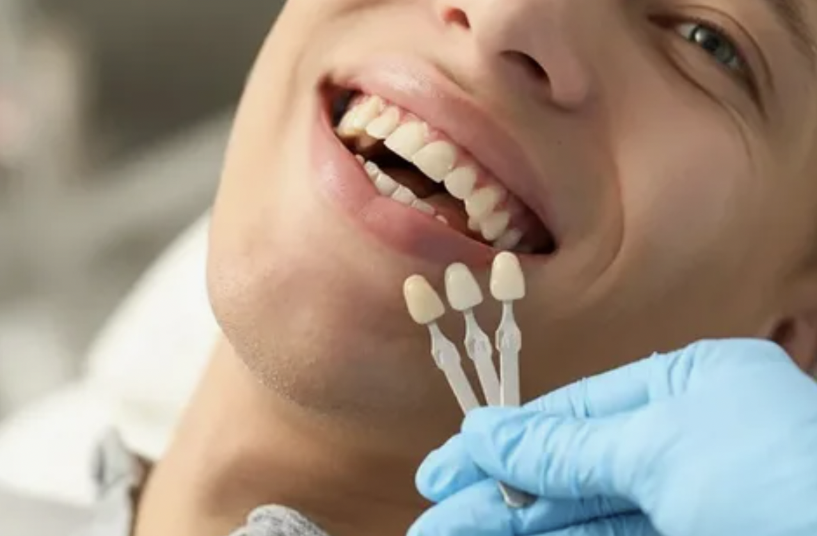 What is Dental Bonding?