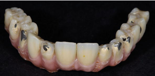Overview of Full-Arch Restoration