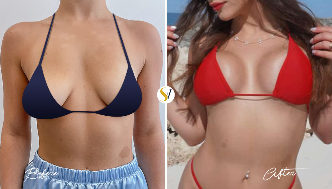 Understanding the Breast Augmentation Procedure