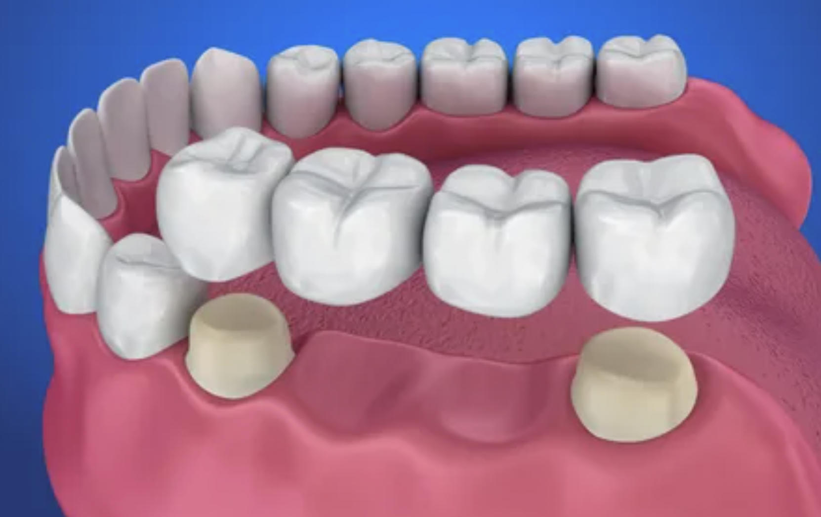 Available Types of Dental Bridges
