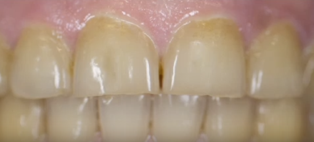 Smile Makeover Planning: The Consultation Process and Realistic Costs