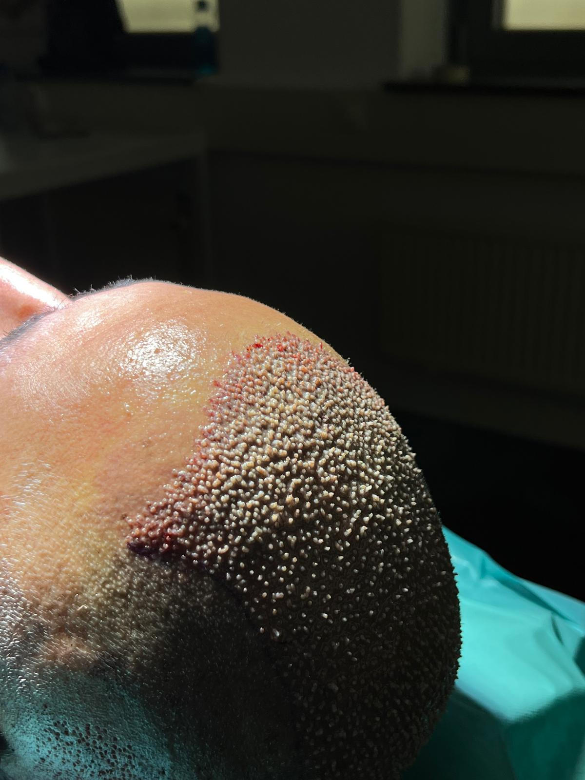 Close-up of DHI technique using Choi pen for precise hair follicle implantation in a hair restoration procedure