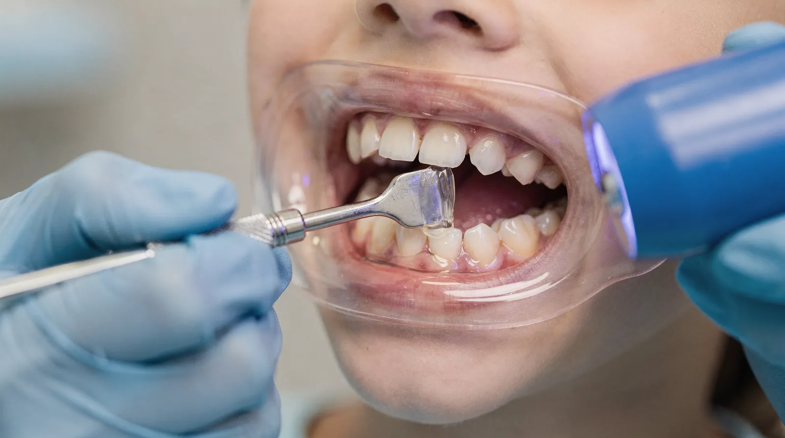Dental Sealants for Children: Benefits and Protection