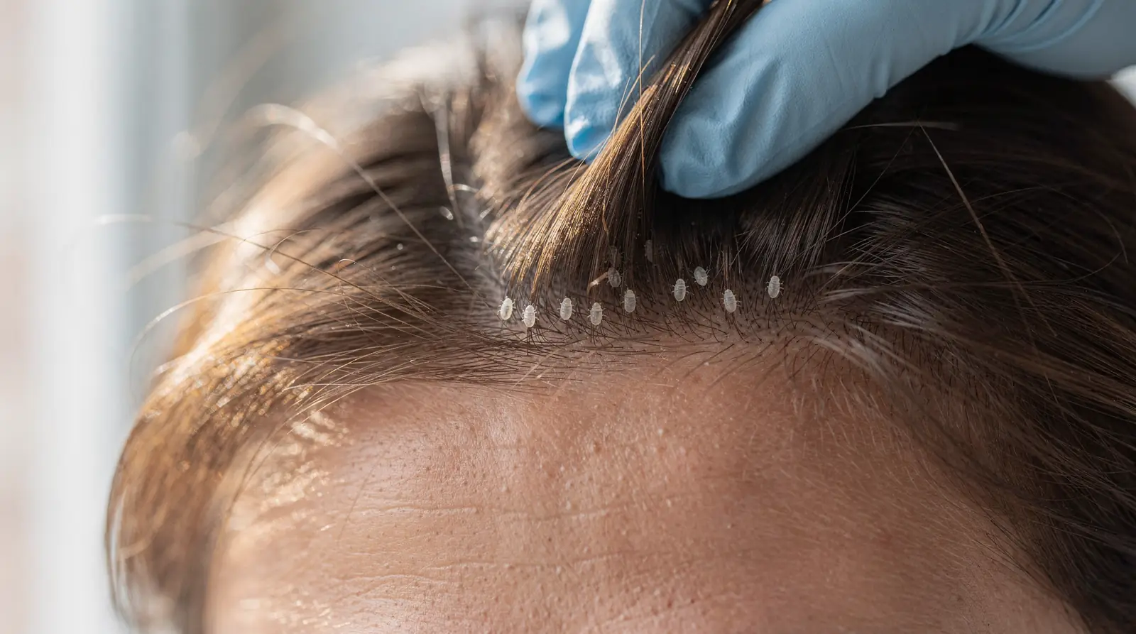 The number of nits and lice present, along with their life-cycle stage, helps determine how The number of nits and lice present, along with their life-cycle stage, helps determine how