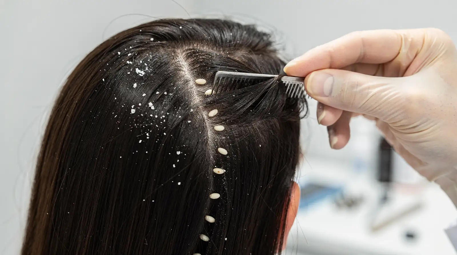 Nits are tiny and might look like dandruff, but unlike flakes they don't come off