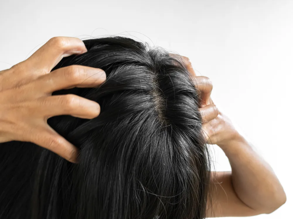 An overhead, close-up view of a person with dark hair scratching their head with both hands, highlighting an itchy scalp and visible white flakes. This image illustrates a need for a Scalp Treatment or natural remedies such as Beef Tallow to address dryness and discomfort.