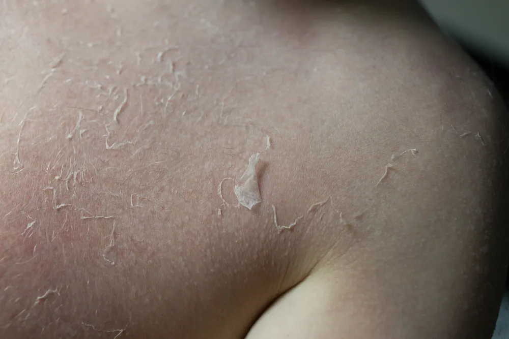 Close-up of severely cracked and irritated skin with a cold sore near the lip, illustrating a condition requiring a supportive skincare routine