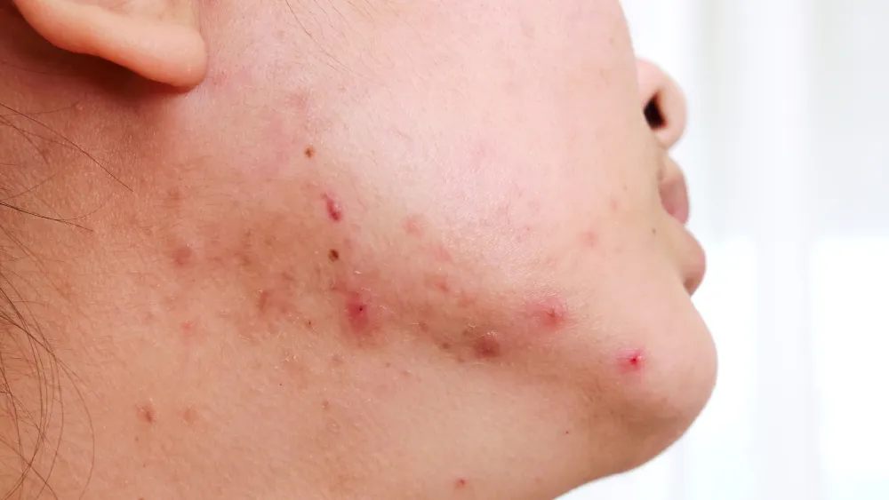Close-up of acne-prone skin on a person's jawline, considering tallow skincare for treatment.