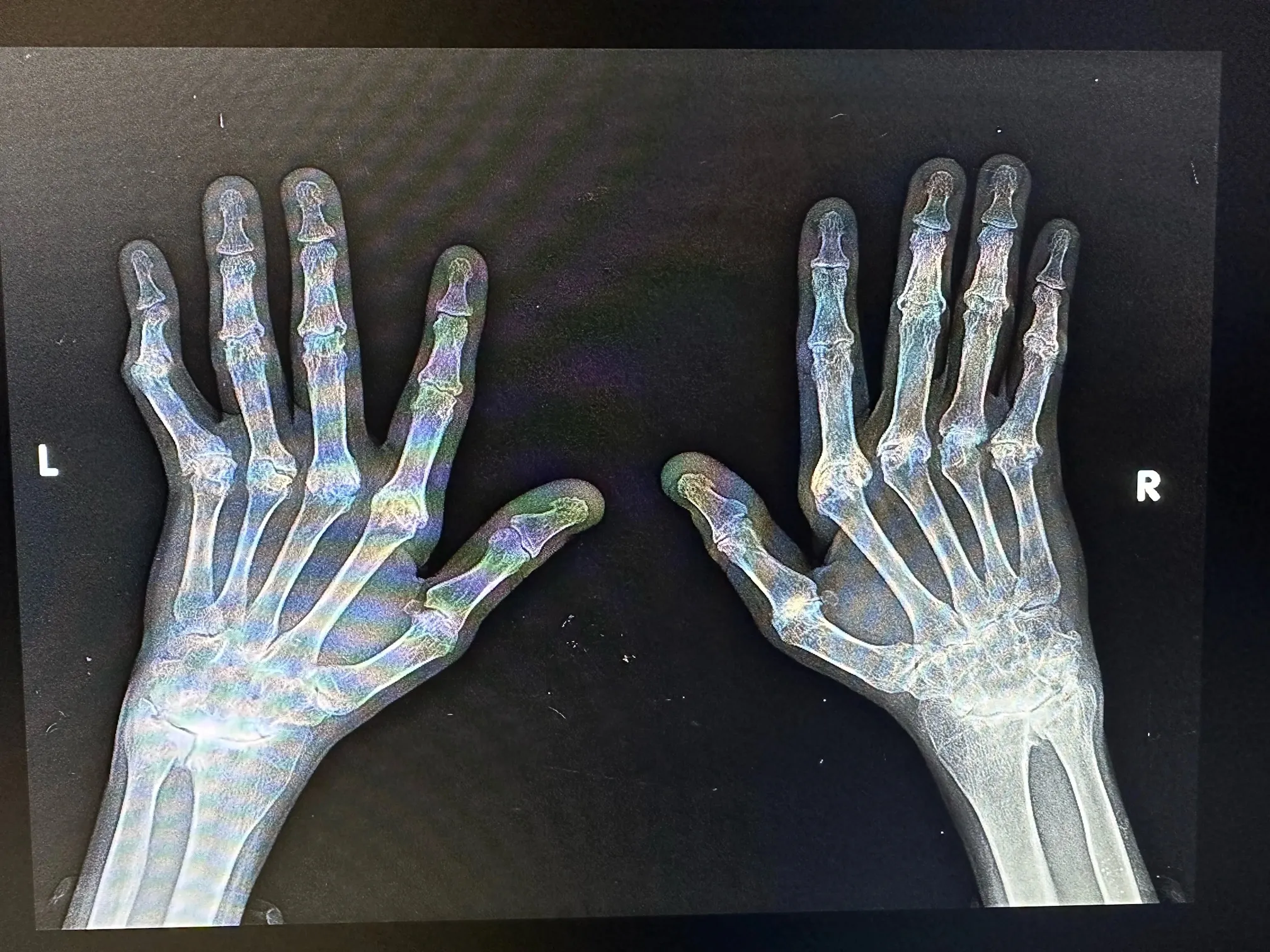 X-ray of Ron Lev's hands showing joint damage from uncontrolled Rheumatoid Arthritis inflammation in the years following his 1995 diagnosis