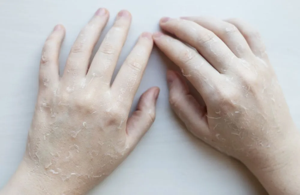 A pair of hands with visible patches of dry, flaking skin, possibly due to peeling from a skin application or extreme dryness, need benefiting from a moisturizing tallow balm treatment A pair of hands with visible patches of dry, flaking skin, possibly due to peeling from a skin application or extreme dryness, need benefiting from a moisturizing tallow balm treatment