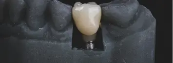 Dental Implants at Issa Dental Group.