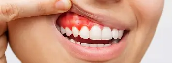 Periodontal disease at Issa Dental Group.