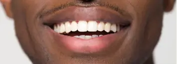 teeth whitening at Issa Dental Group.