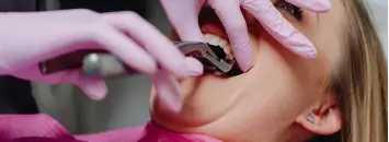 oral surgery extractions at Issa Dental Group.