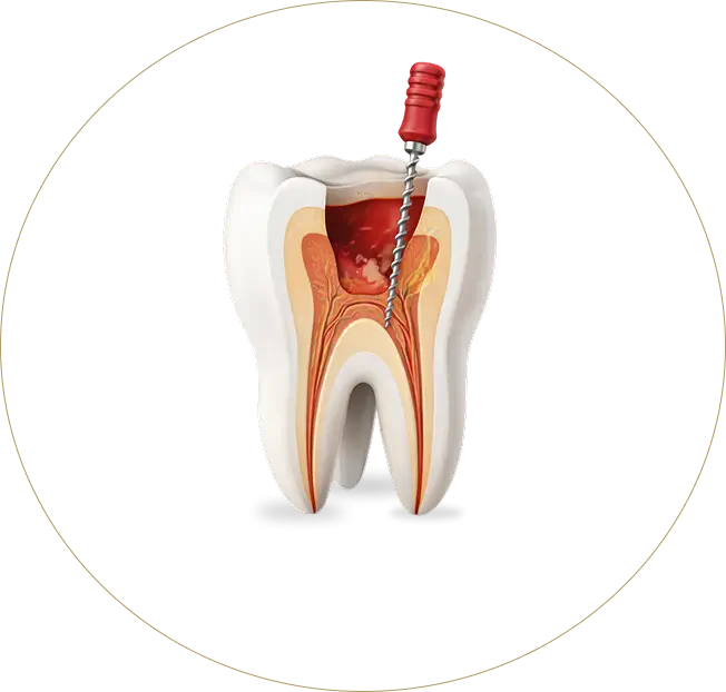 A detailed 3D cross-section illustration of a molar tooth undergoing root canal treatment at Issa Dental, showing a dental file cleaning out an infected root canal.