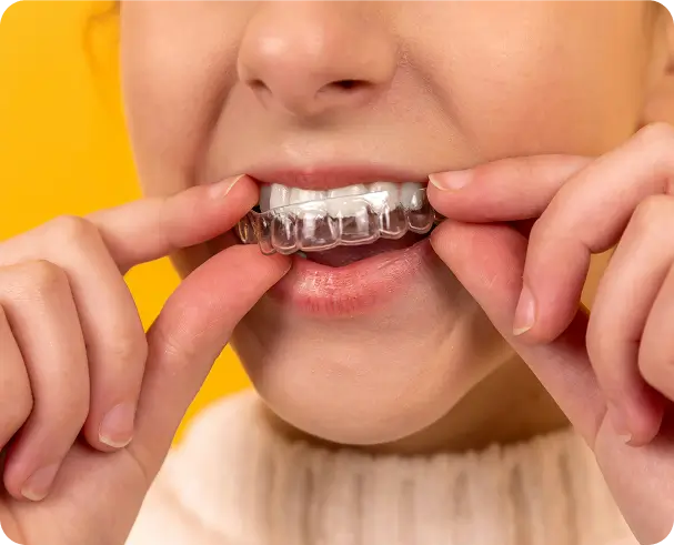A patient easily inserting custom-made, virtually invisible Invisalign clear aligners at Issa Dental for comfortable teeth straightening.