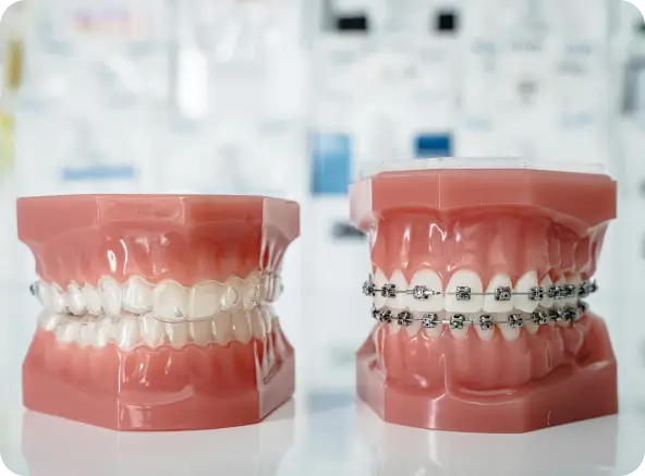 A side-by-side comparison of dental models showing Invisalign clear aligners on the left and traditional metal braces on the right at Issa Dental.