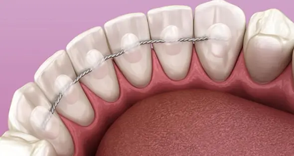 Illustration of a permanent bonded wire retainer attached to the back of the teeth for long-term stability at Issa Dental Group.