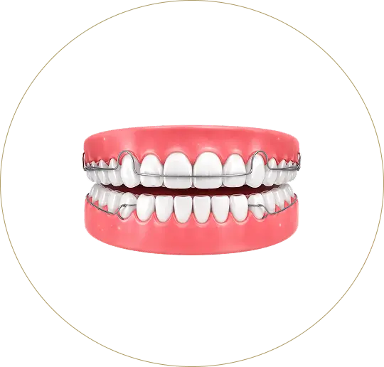 A traditional Hawley retainer with metal wires on a dental model, illustrating when to seek a replacement at Issa Dental Group.