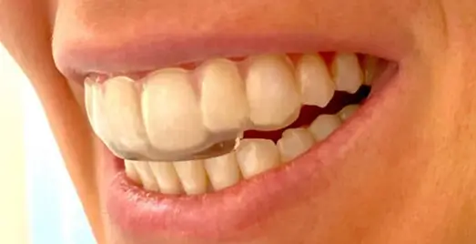 Close-up of a person wearing a transparent front teeth night guard for anterior dental protection.