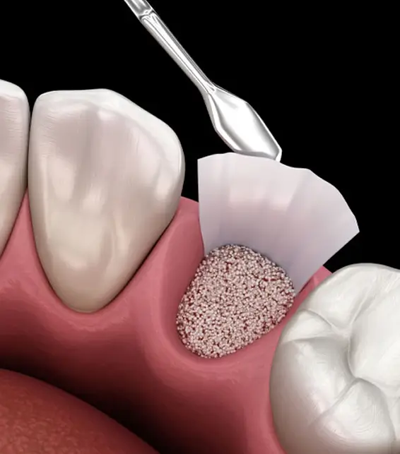 3D medical illustration showing a socket preservation procedure with bone graft material being placed into a tooth extraction site.